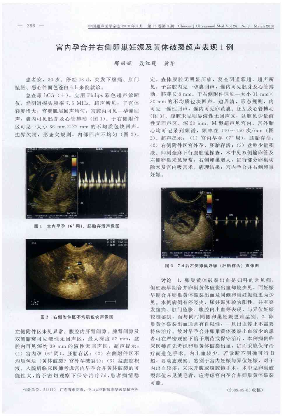 期刊宫内孕合并右侧卵巢妊娠及黄体破裂超声表现1例被引量:1
