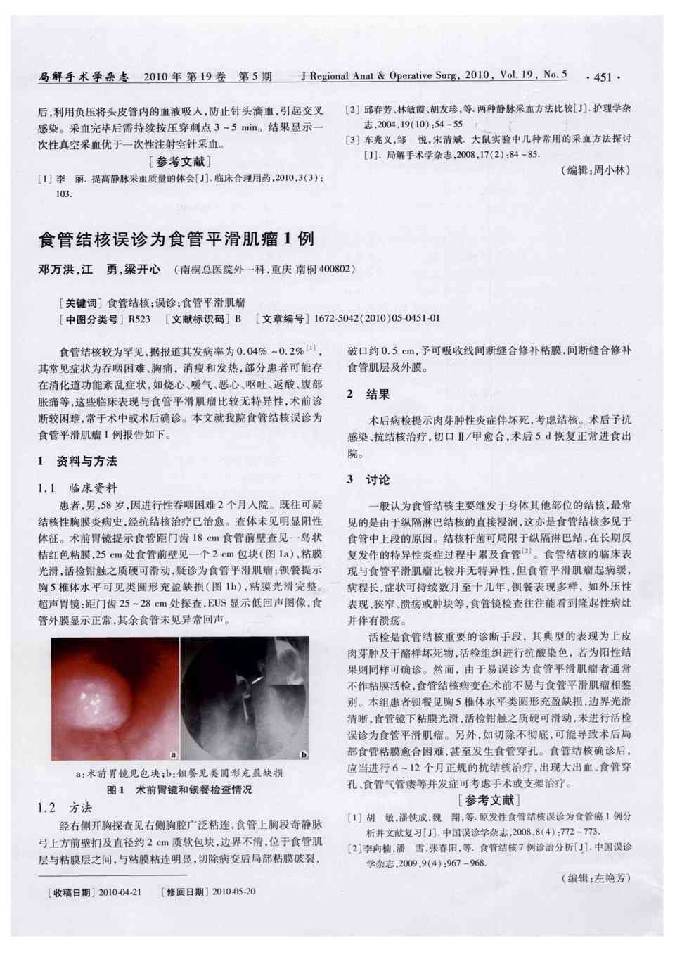 期刊食管结核误诊为食管平滑肌瘤1例被引量:4     食管结核较为罕见