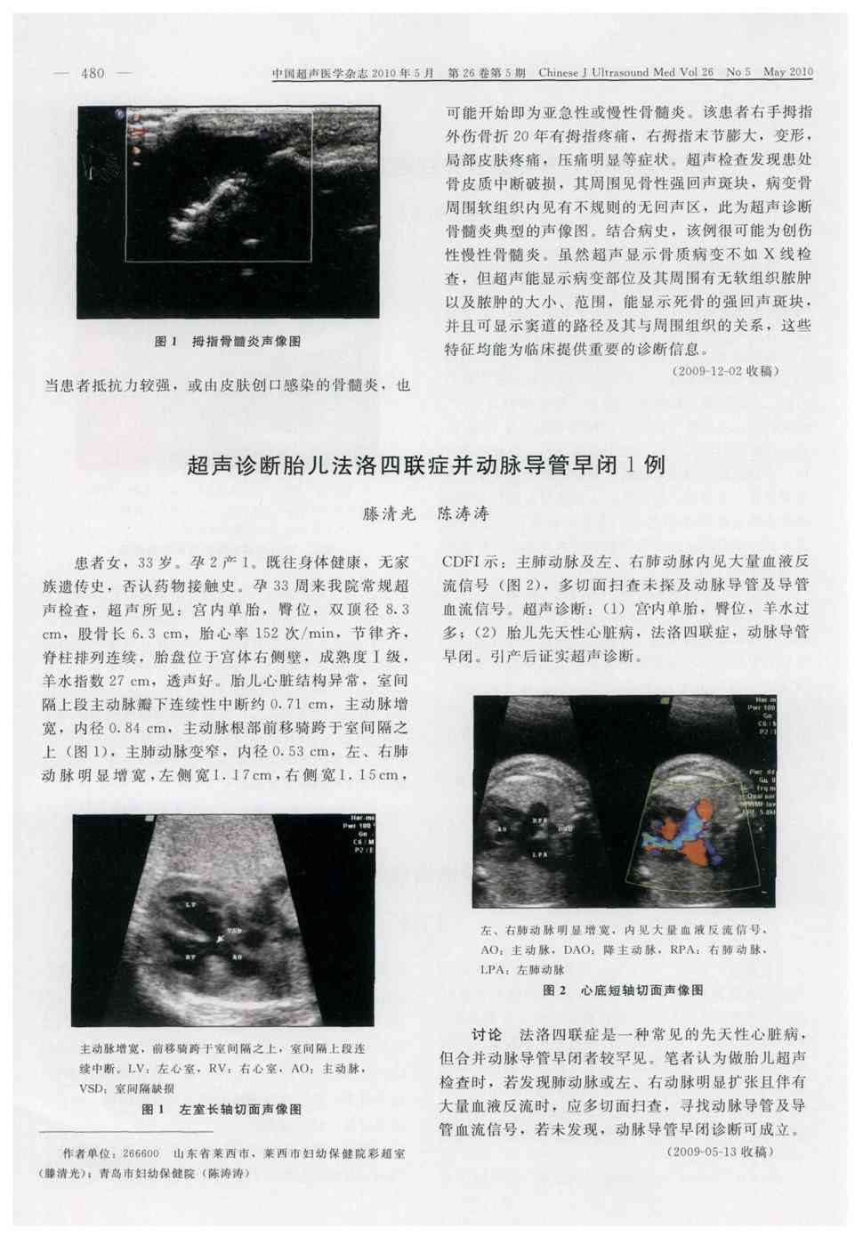 期刊超声诊断胎儿法洛四联症并动脉导管早闭1例    患者女,33岁.