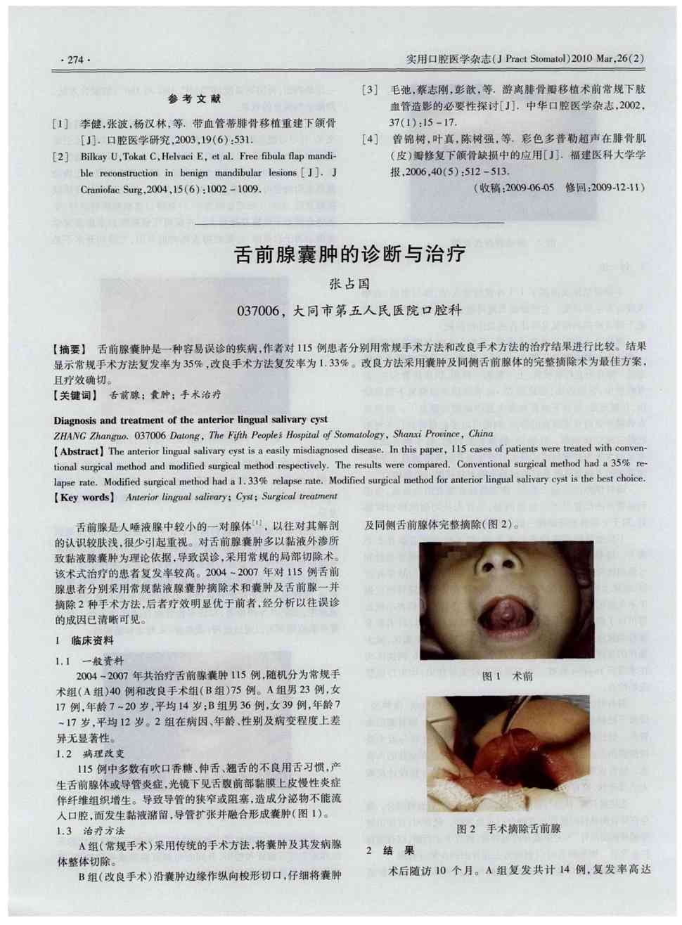 期刊舌前腺囊肿的诊断与治疗被引量:2   舌前腺囊肿是一种容易误诊的