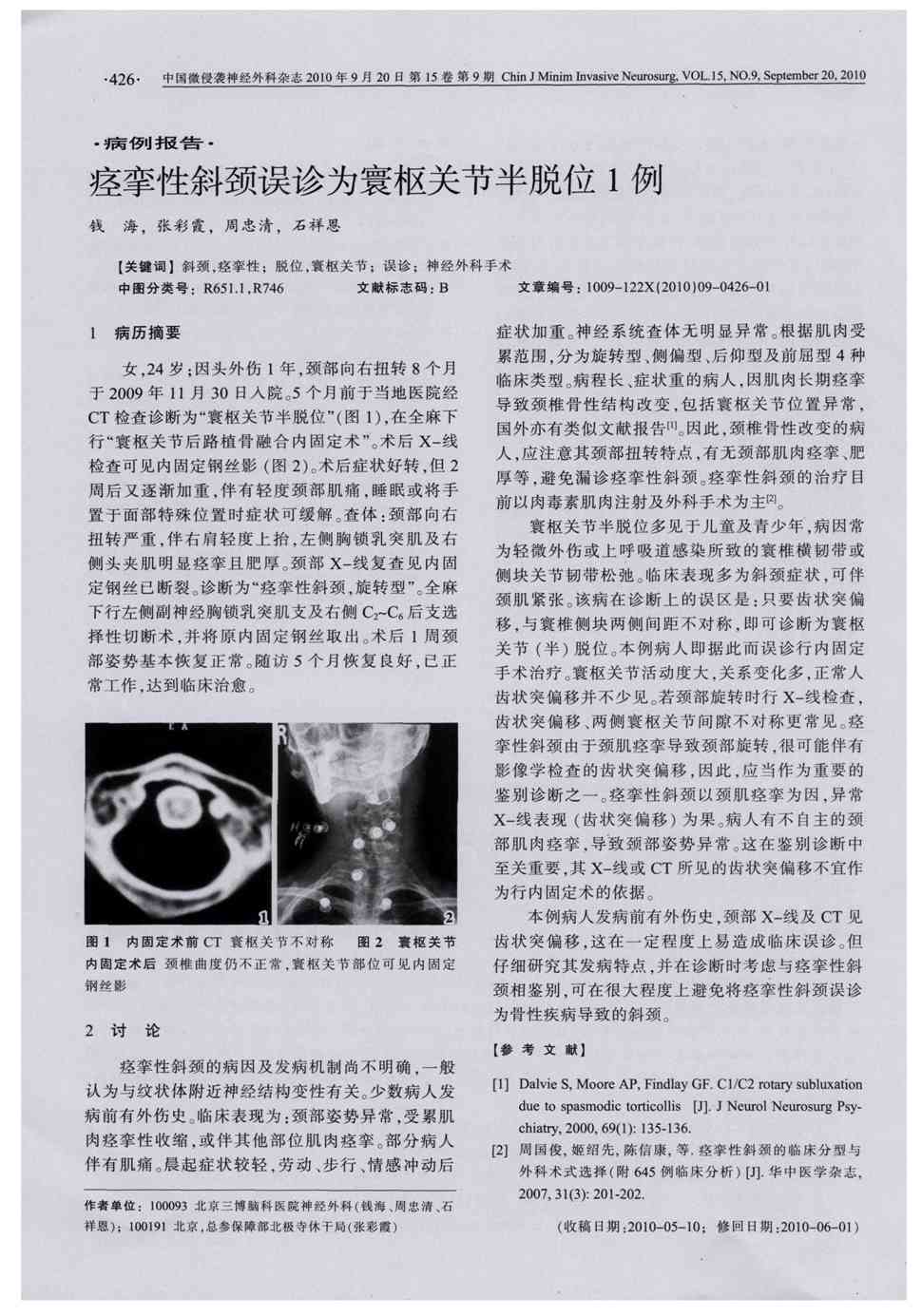 期刊痉挛性斜颈误诊为寰枢关节半脱位1例