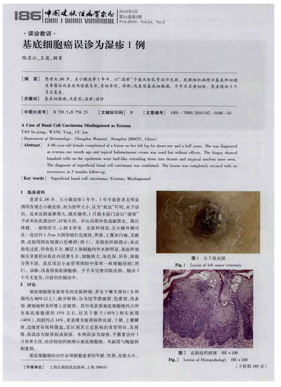 期刊基底细胞癌误诊为湿疹1例被引量:3     患者女,66岁.