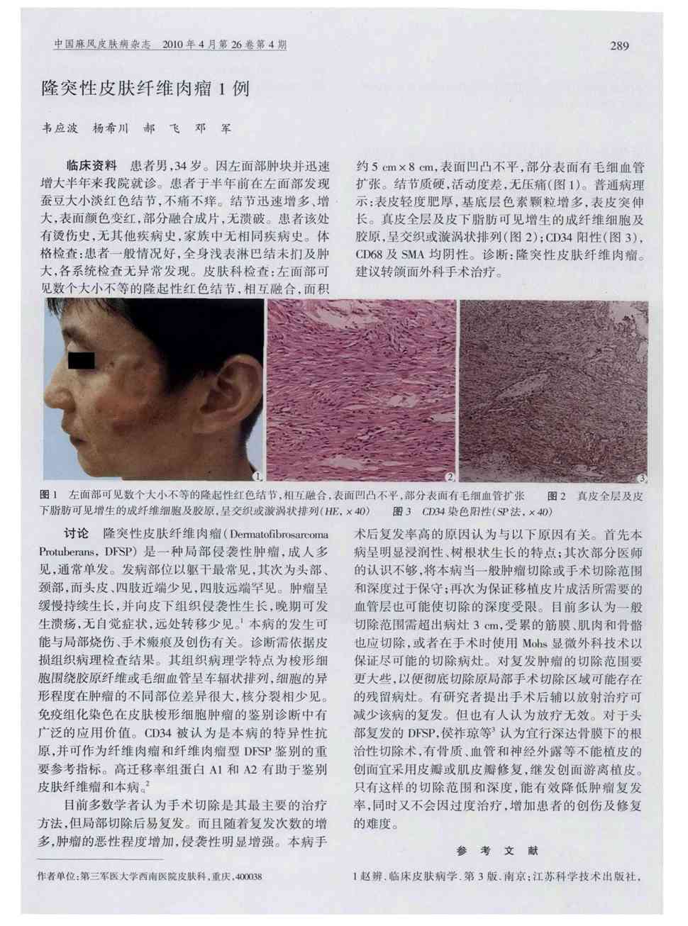 期刊隆突性皮肤纤维肉瘤1例      临床资料患者男,34岁.