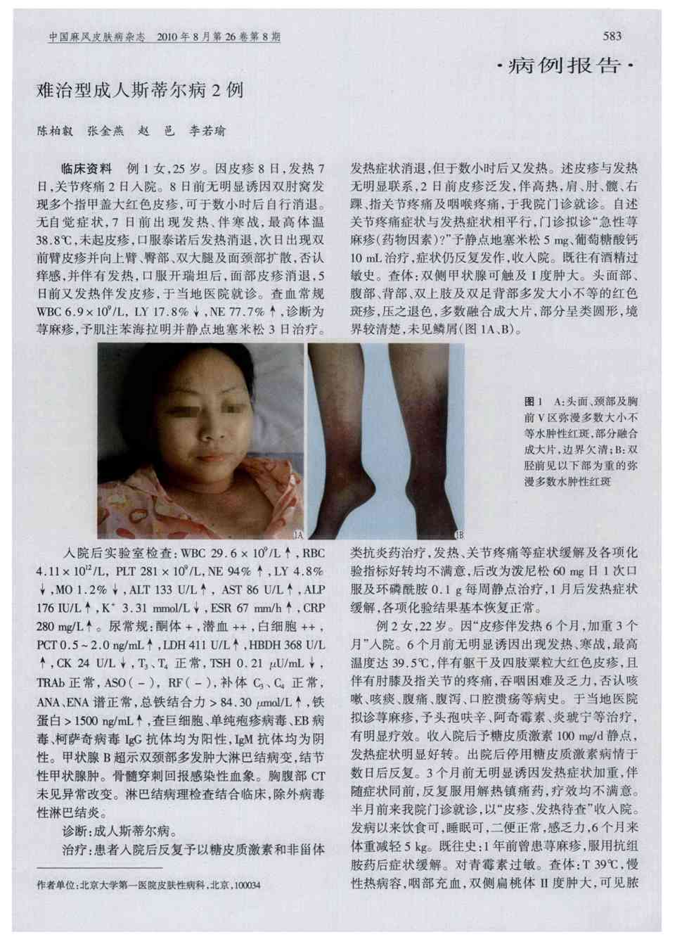 期刊难治型成人斯蒂尔病2例      临床资料 例 1女,25岁.