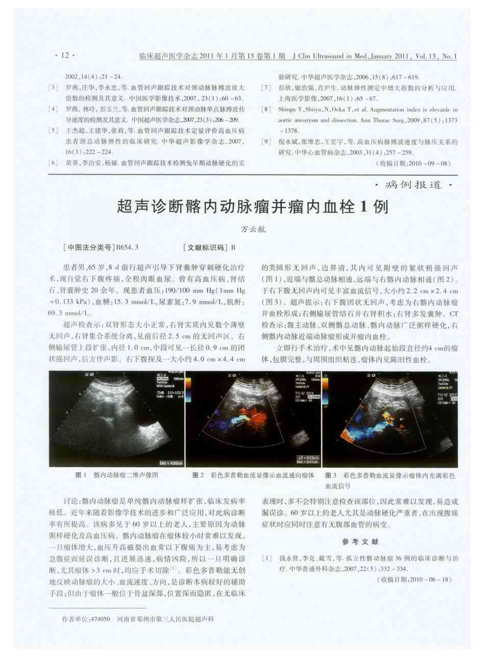 期刊超声诊断髂内动脉瘤并瘤内血栓1例被引量:1   患者男,65岁,8d