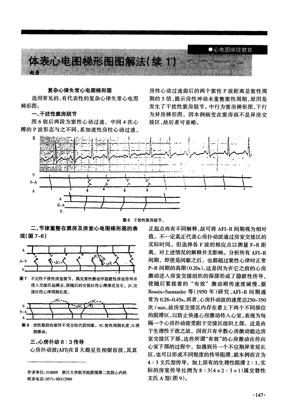 期刊体表心电图梯形图图解法(续1)被引量:1   复杂心律失常心电图