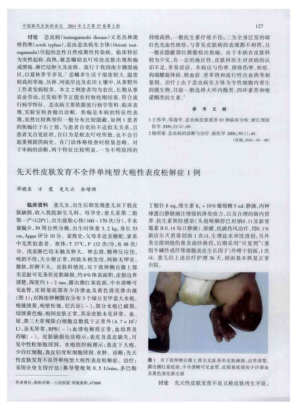 期刊先天性皮肤发育不全伴单纯型大疱性表皮松解症1例      临床资料