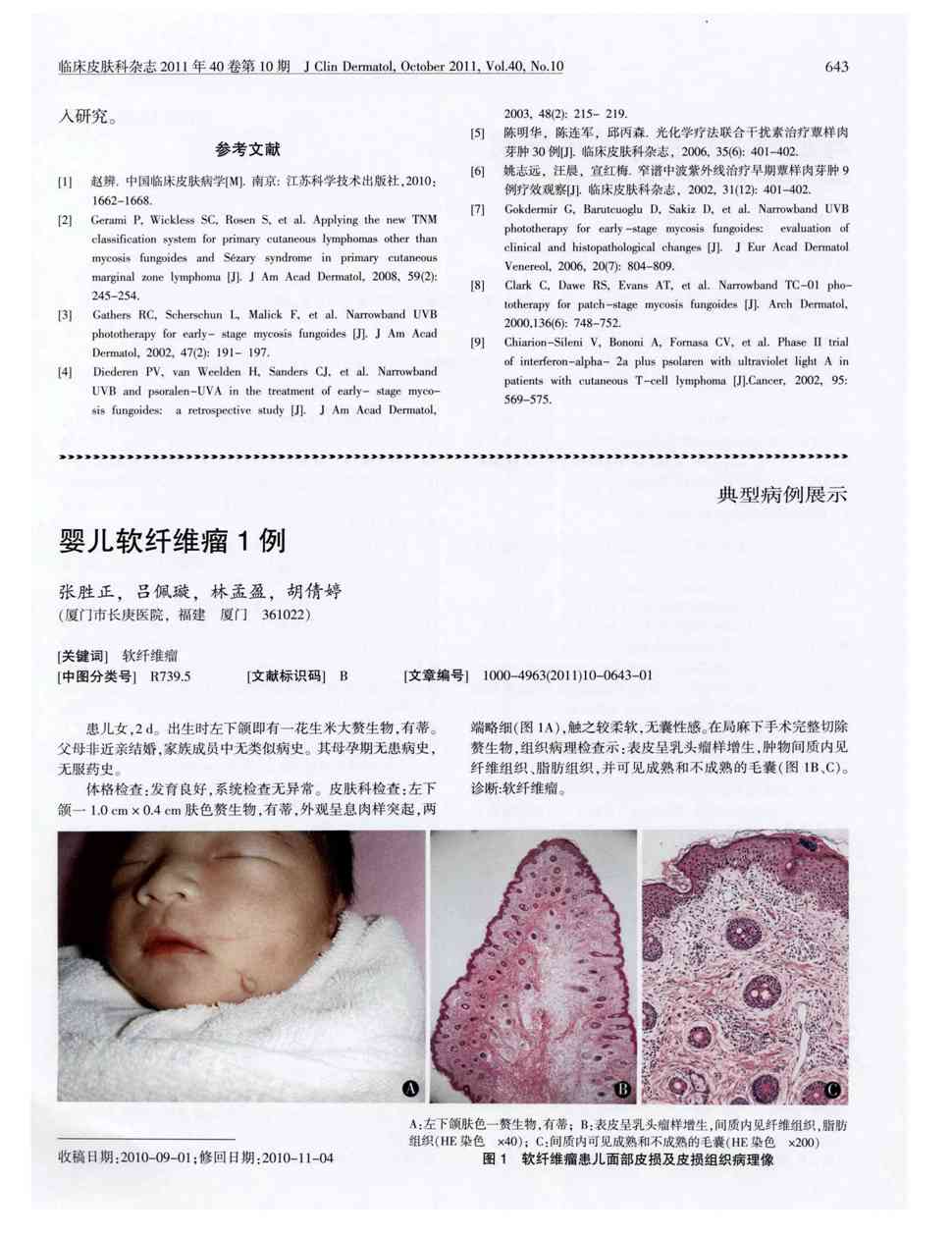 期刊婴儿软纤维瘤1例被引量:1