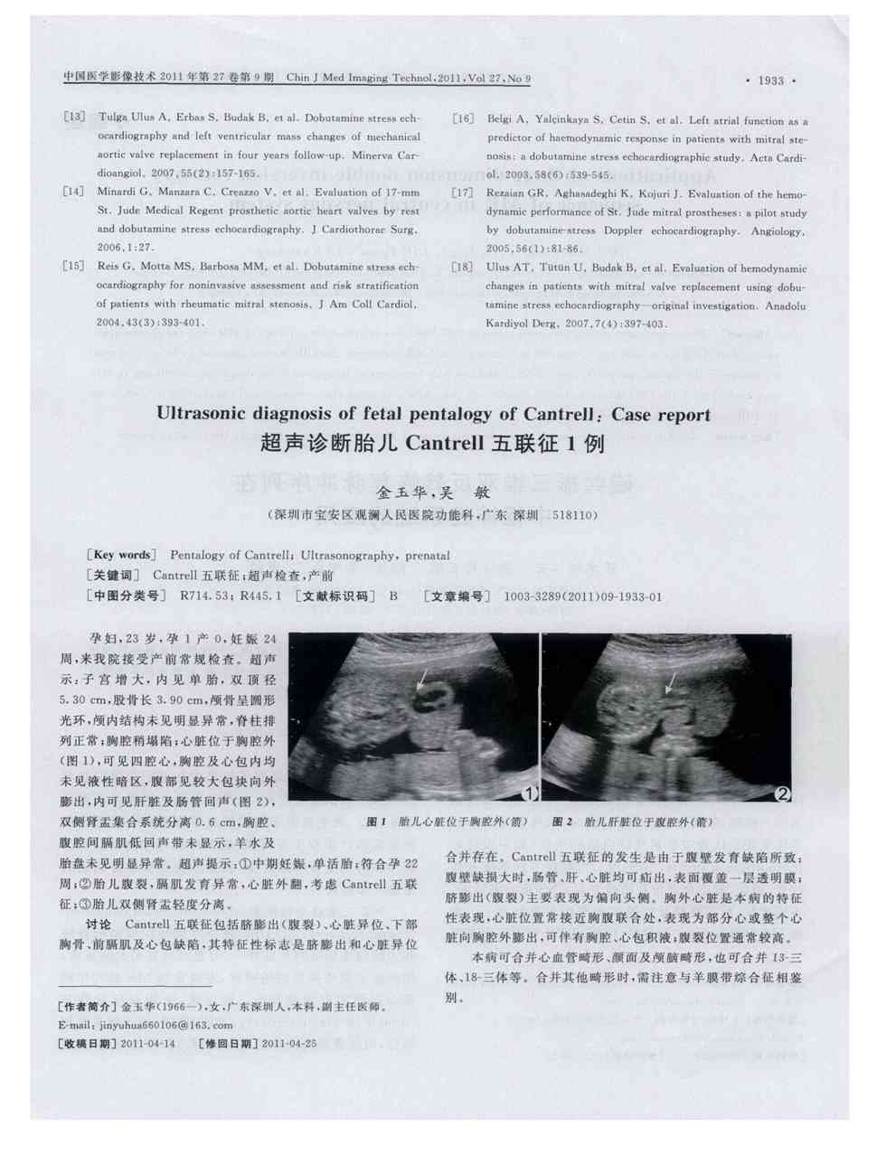 期刊超声诊断胎儿cantrell五联征1例    孕妇,23岁,孕1产0,妊娠24周