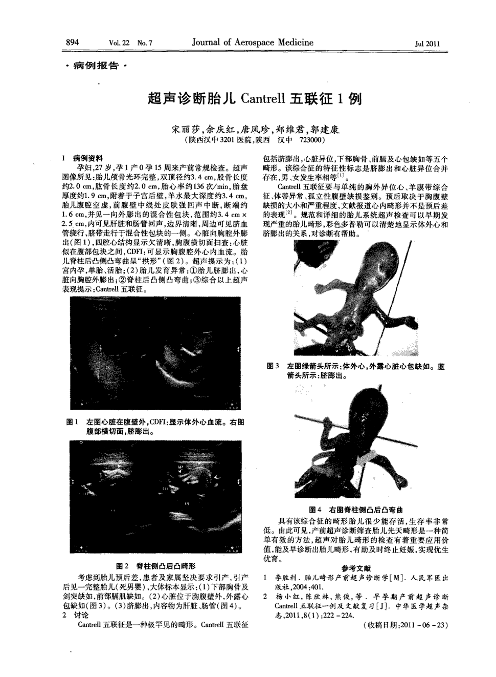 期刊超声诊断胎儿cantrell五联征1例被引量:1       1病例资料孕妇