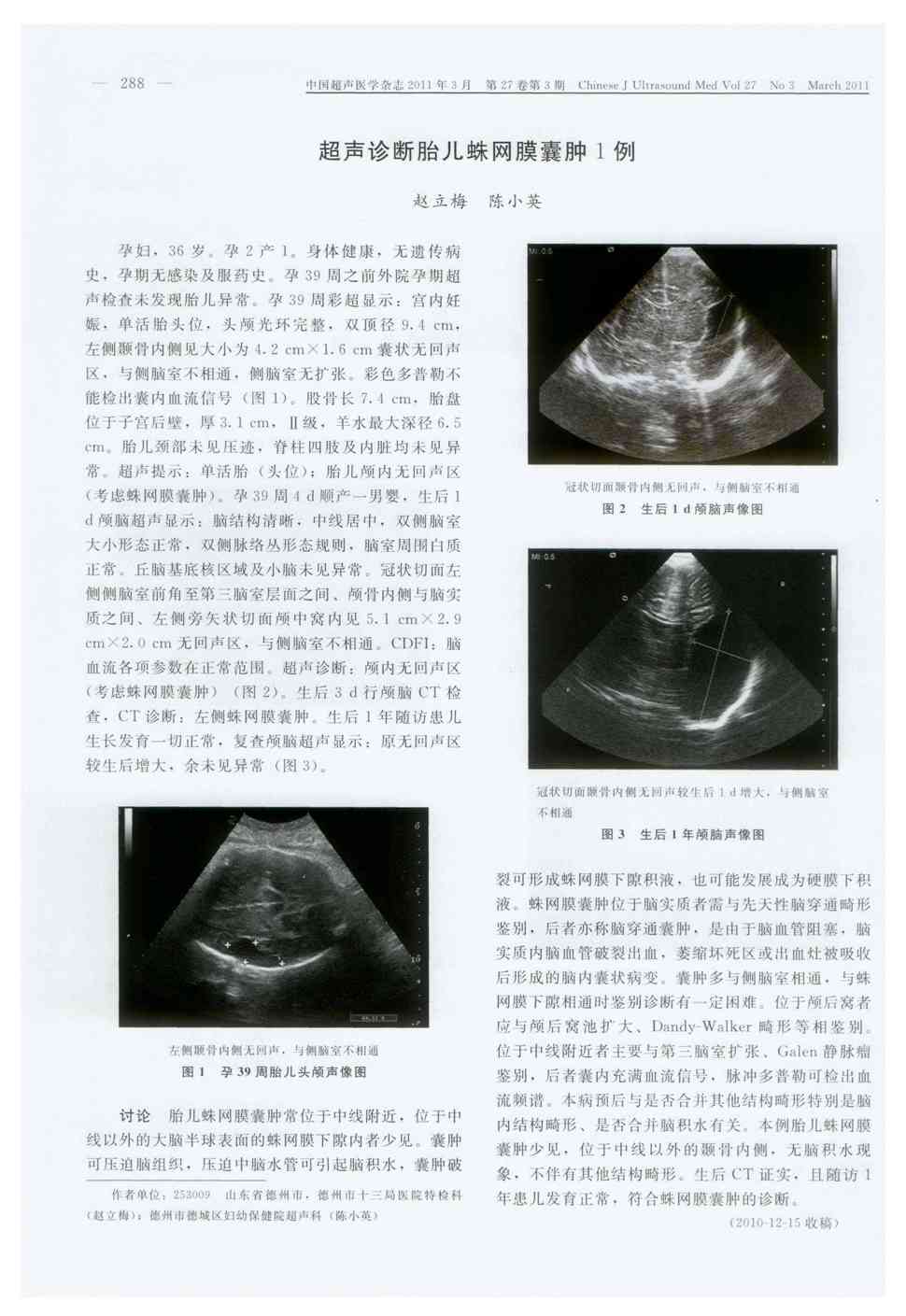 期刊超声诊断胎儿蛛网膜囊肿1例被引量:1