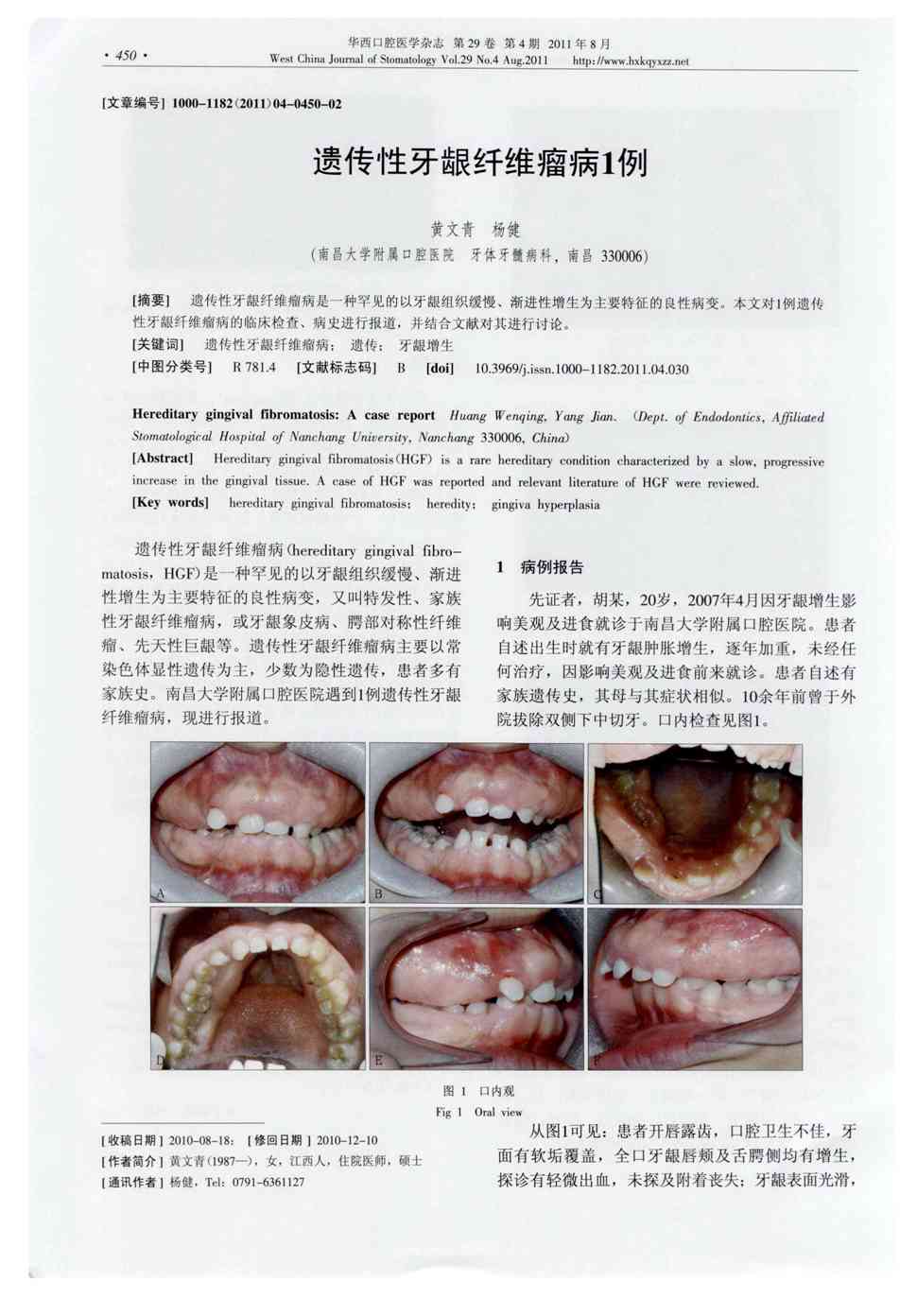 期刊遗传性牙龈纤维瘤病1例被引量:4    遗传性牙龈纤维瘤病是一种