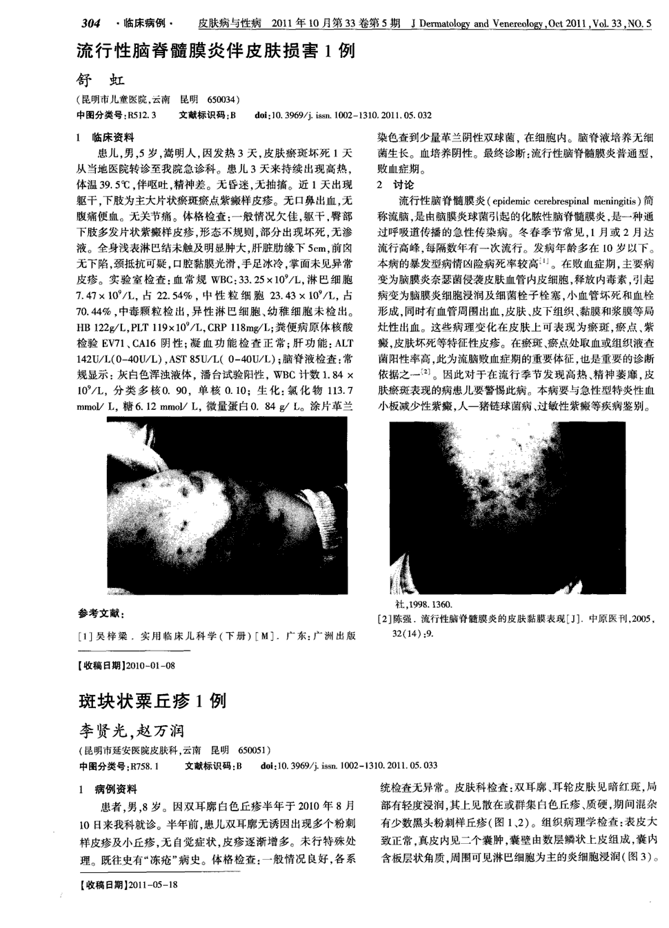 期刊流行性脑脊髓膜炎伴皮肤损害1例   患儿,男,5岁,嵩明人,因发热3
