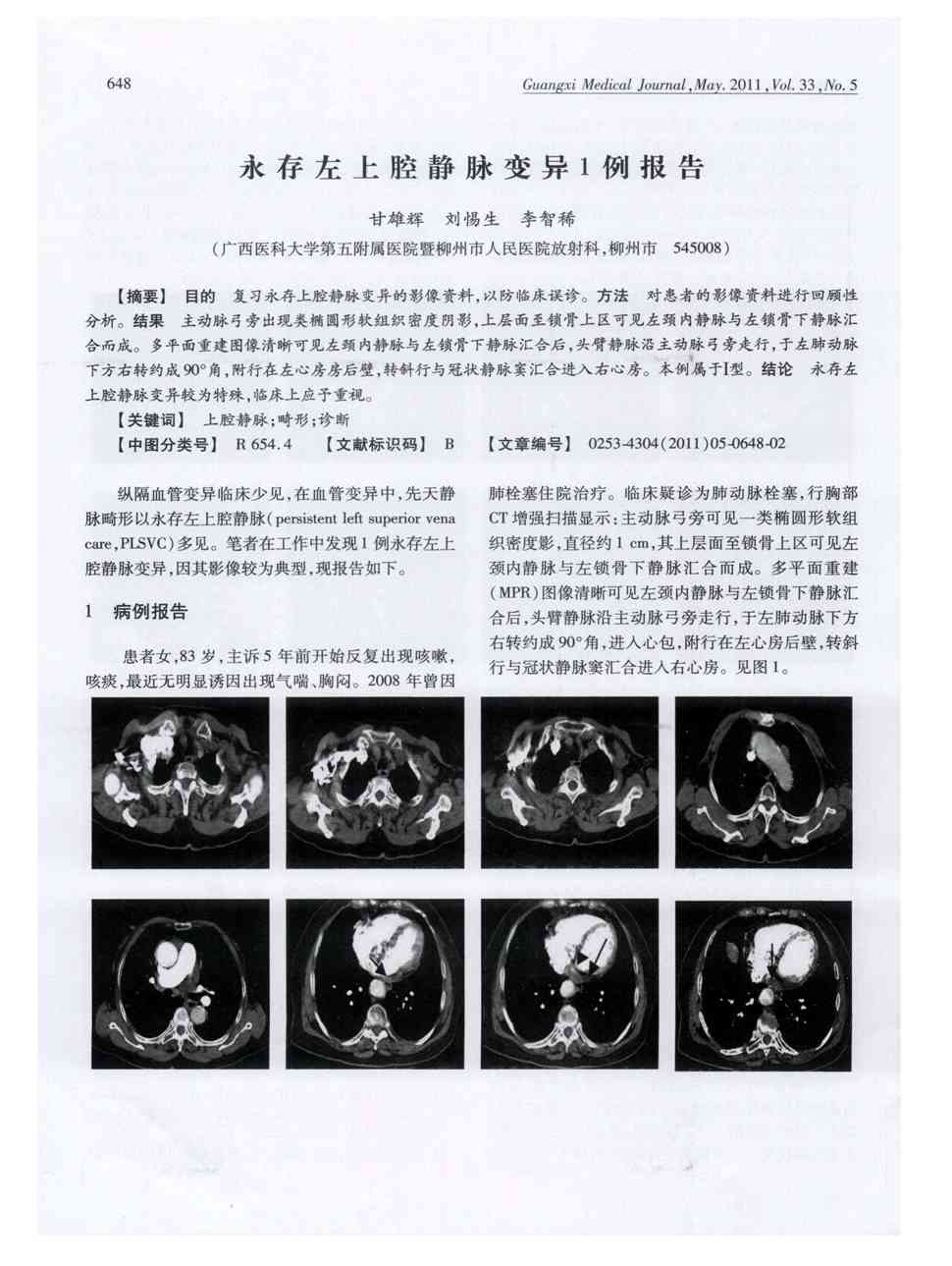 期刊永存左上腔静脉变异1例报告被引量:2     目的复习永存上腔静脉