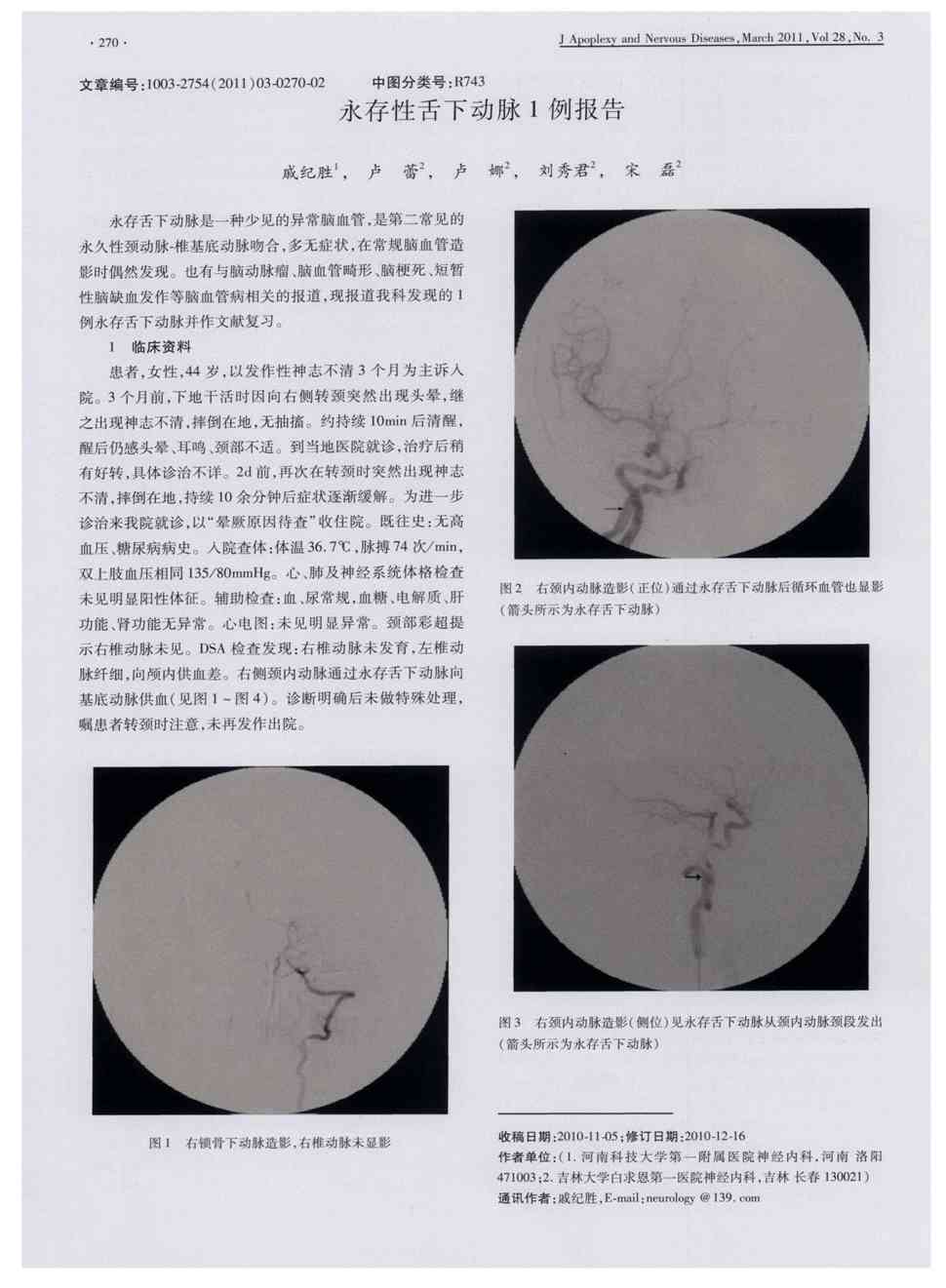 期刊永存性舌下动脉1例报告被引量:3       永存舌下动脉是一种少见