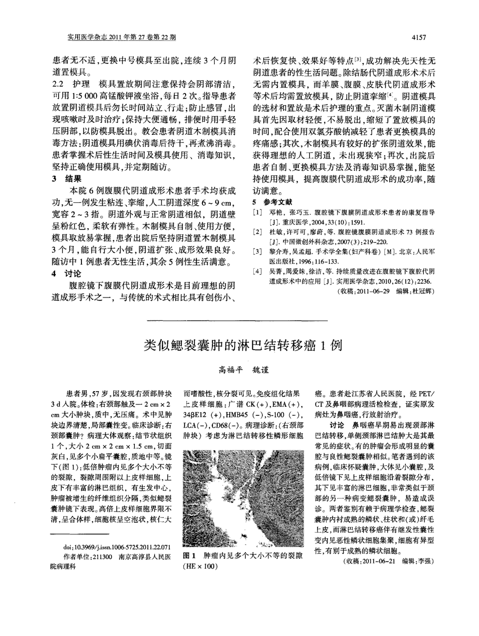 期刊类似鳃裂囊肿的淋巴结转移癌1例    患者男,57岁,因发现右颈部