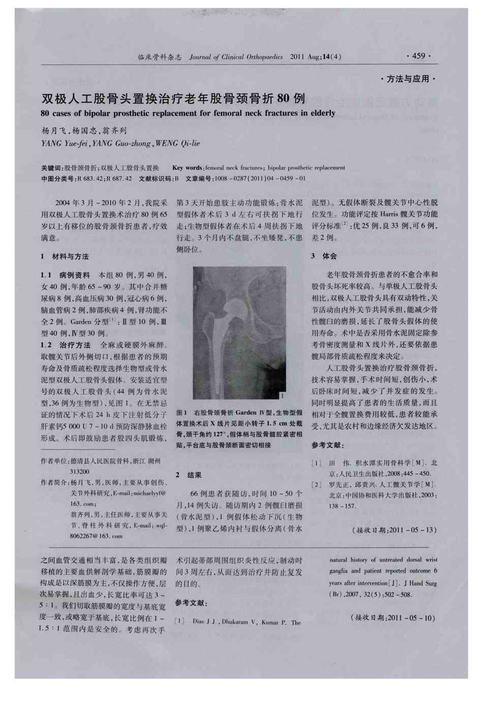 期刊双极人工股骨头置换治疗老年股骨颈骨折80例被引量:3     2004年