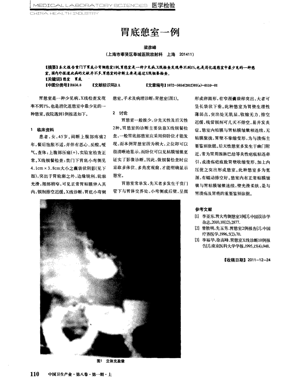 期刊胃底憩室一例   本文报告贲门下胃底小弯侧憩室1例,胃憩室是一种