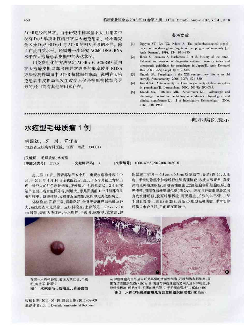 期刊水疱型毛母质瘤1例被引量:1     患儿男,11岁.