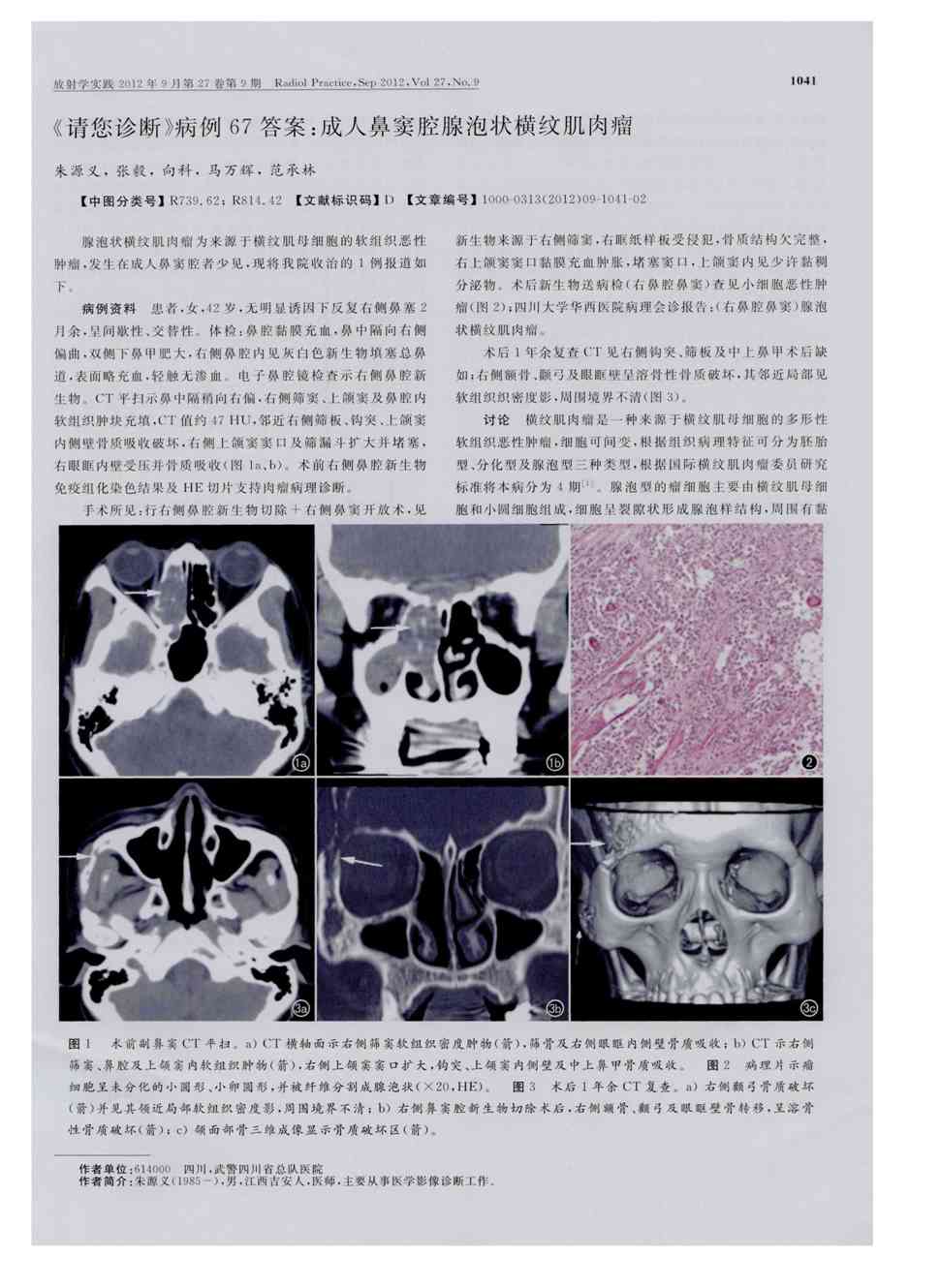 期刊《请您诊断》病例67答案:成人鼻窦腔腺泡状横纹肌肉瘤