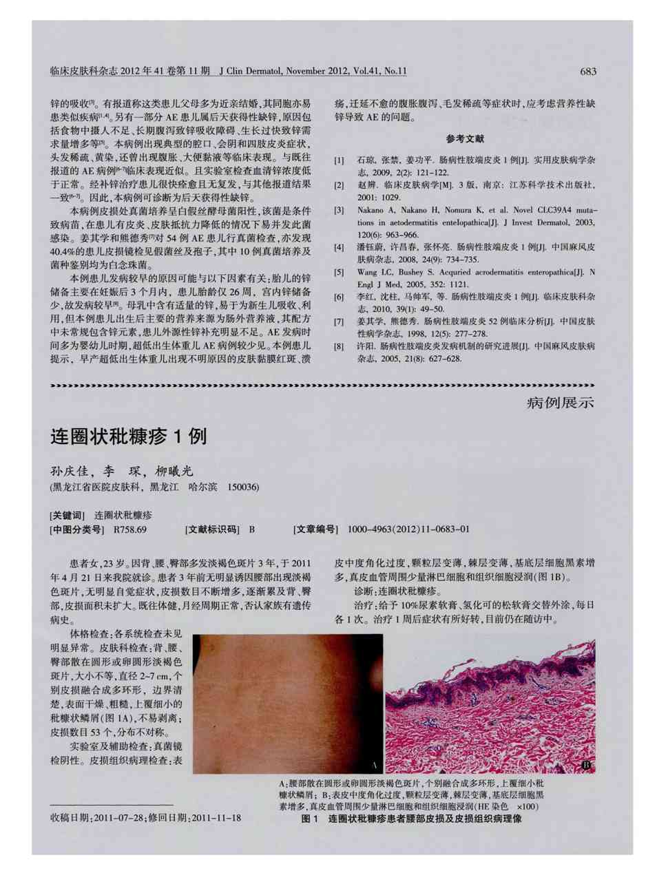 期刊连圈状秕糠疹1例     患者女,23岁.