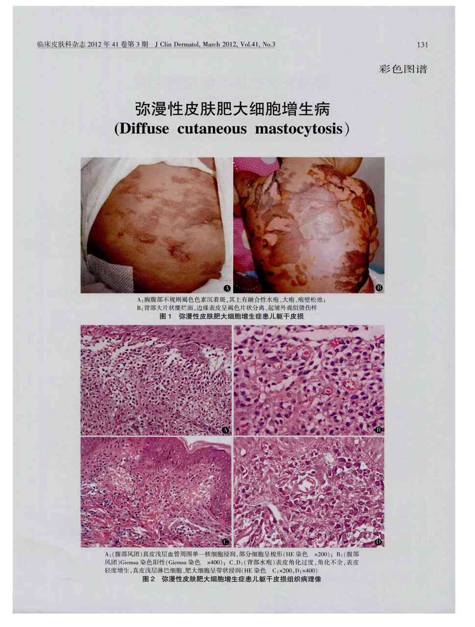 期刊弥漫性皮肤肥大细胞增生病     患儿男,7个月.