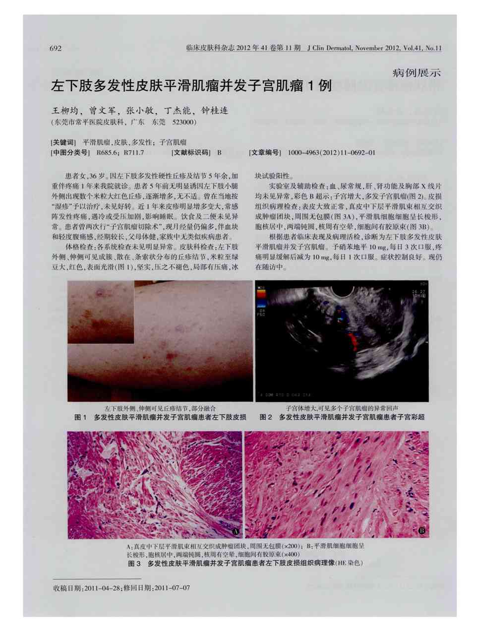 期刊左下肢多发性皮肤平滑肌瘤并发子宫肌瘤1例被引量:1       患者