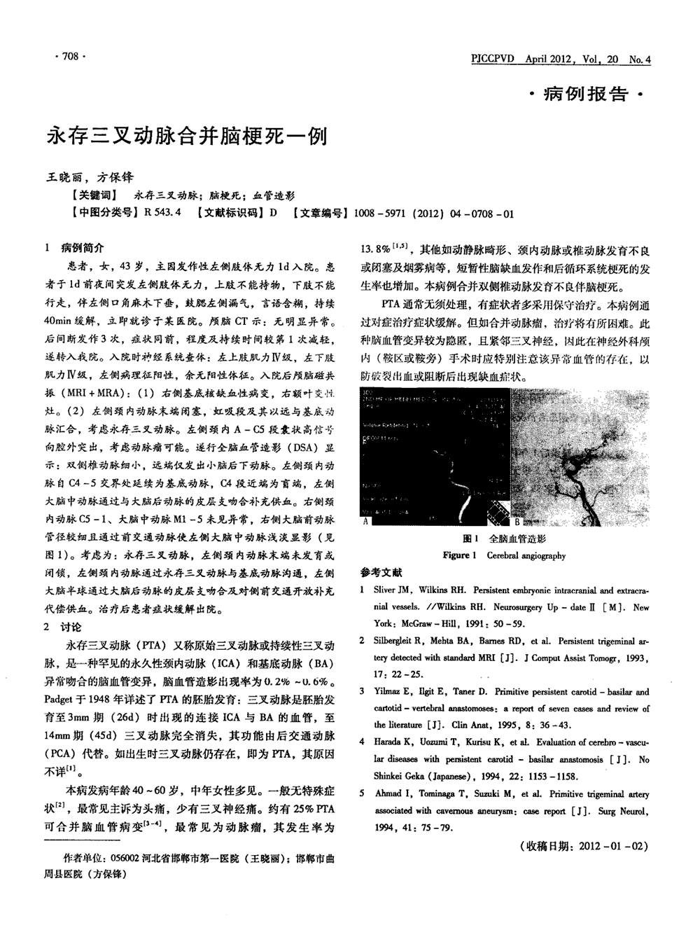 期刊永存三叉动脉合并脑梗死一例    1病例简介  患者,女,43岁,主因