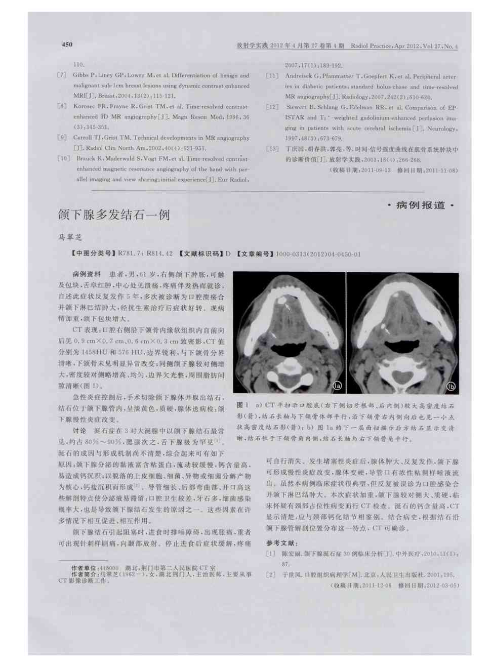 期刊颌下腺多发结石一例被引量:1   病例资料患者,男,61岁,右侧颌下