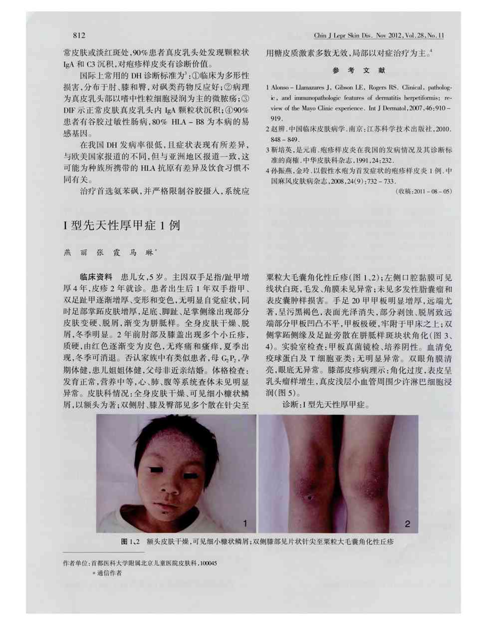 期刊Ⅰ型先天性厚甲症1例     临床资料患儿女,5岁.