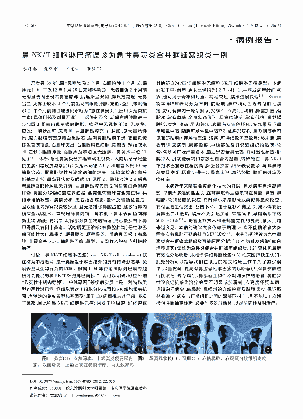 期刊鼻nk/t细胞淋巴瘤误诊为急性鼻窦炎合并眶蜂窝织炎一例