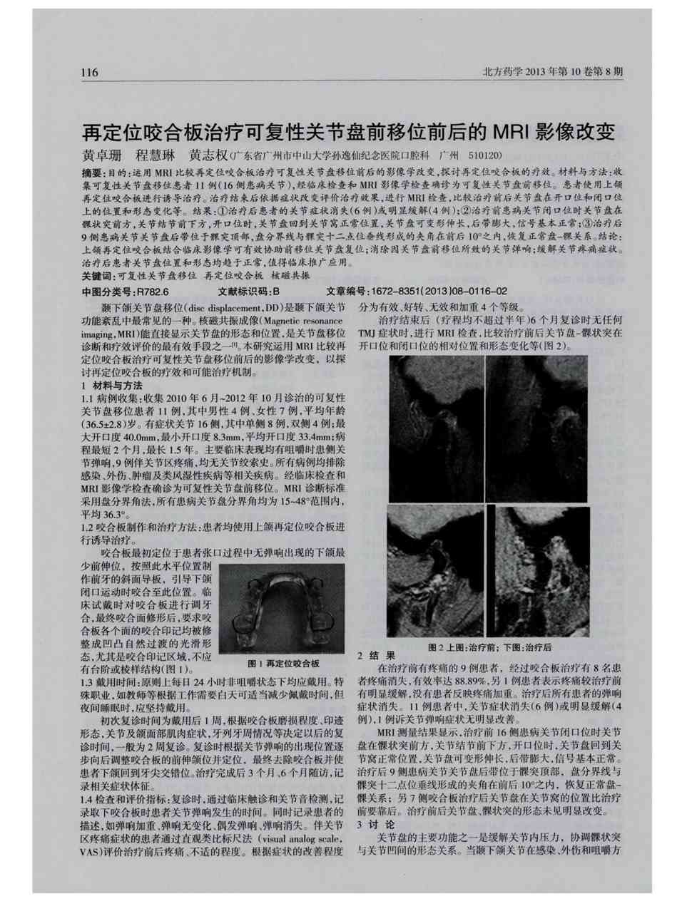 期刊再定位咬合板治疗可复性关节盘前移位前后的mri影像改变被引量:1