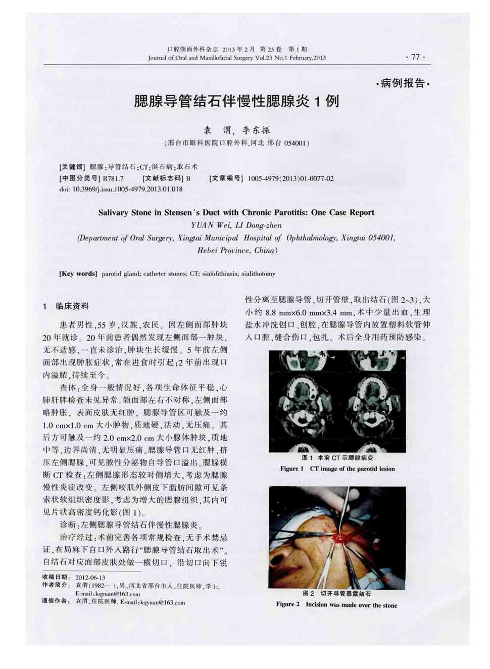 期刊腮腺导管结石伴慢性腮腺炎1例    患者男性,55岁,汉族,农民.