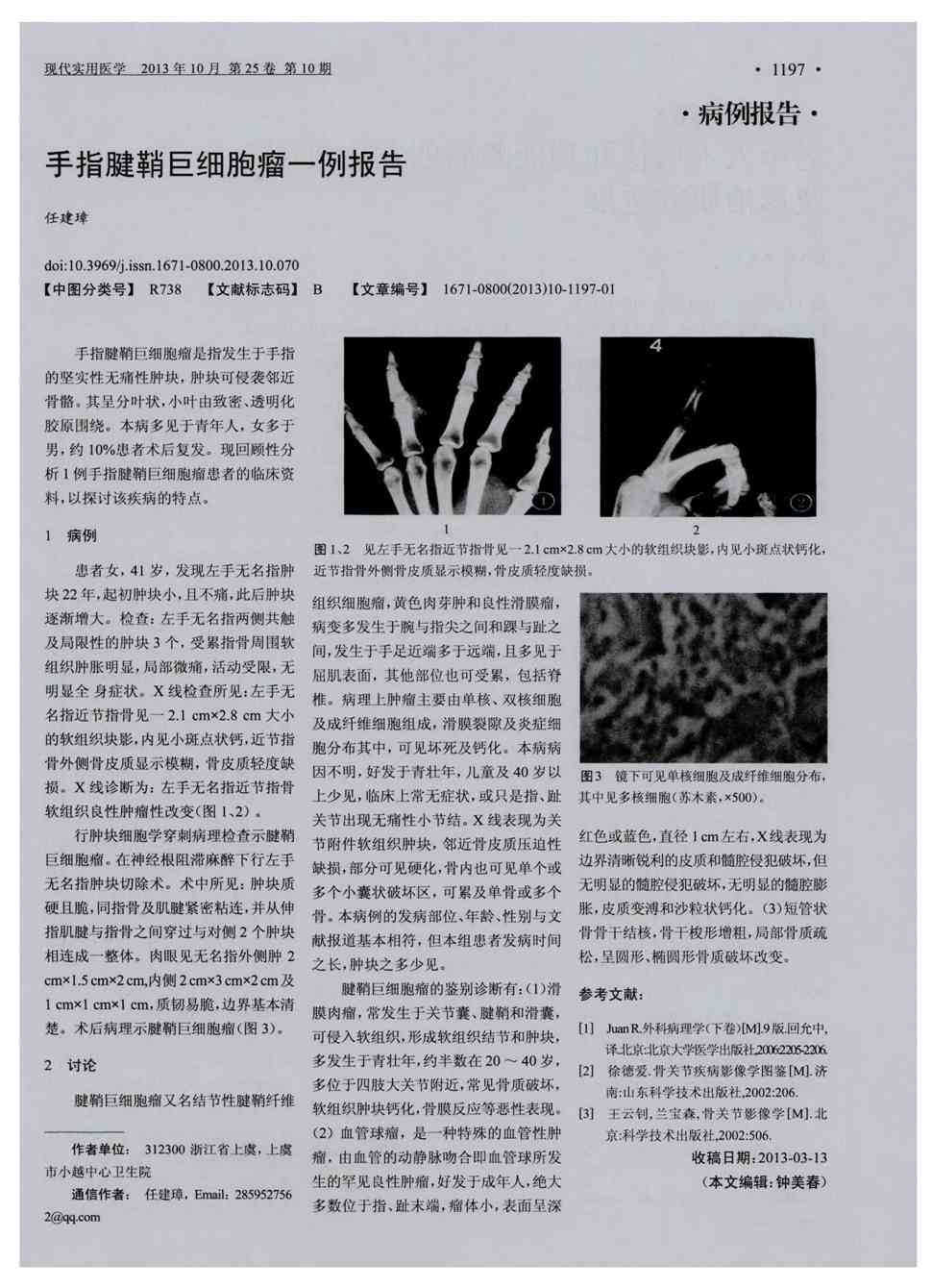 期刊手指腱鞘巨细胞瘤一例报告   手指腱鞘巨细胞瘤是指发生于手指的