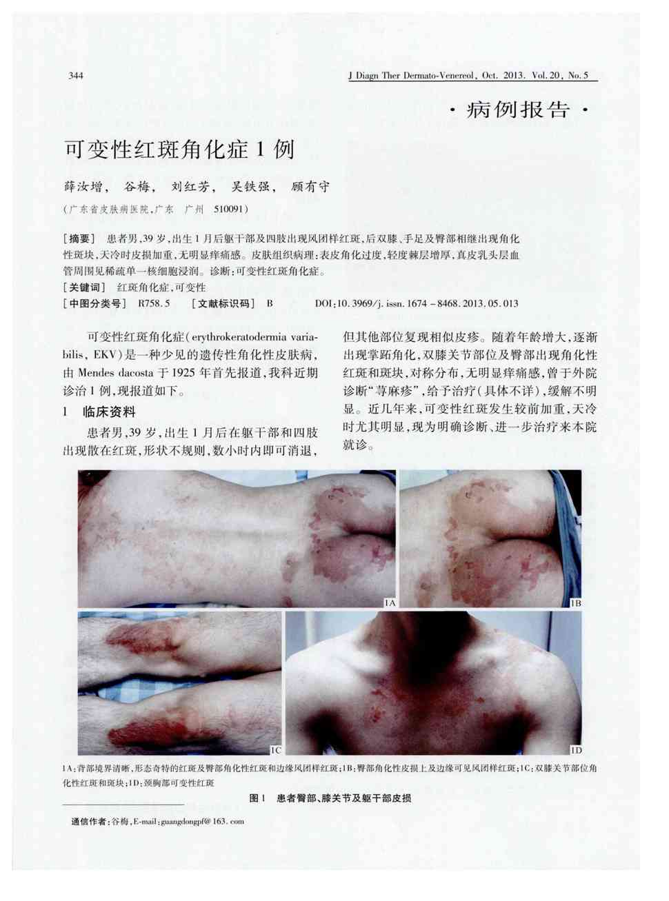 期刊可变性红斑角化症1例       患者男,39岁,出生1月后躯下部及四肢