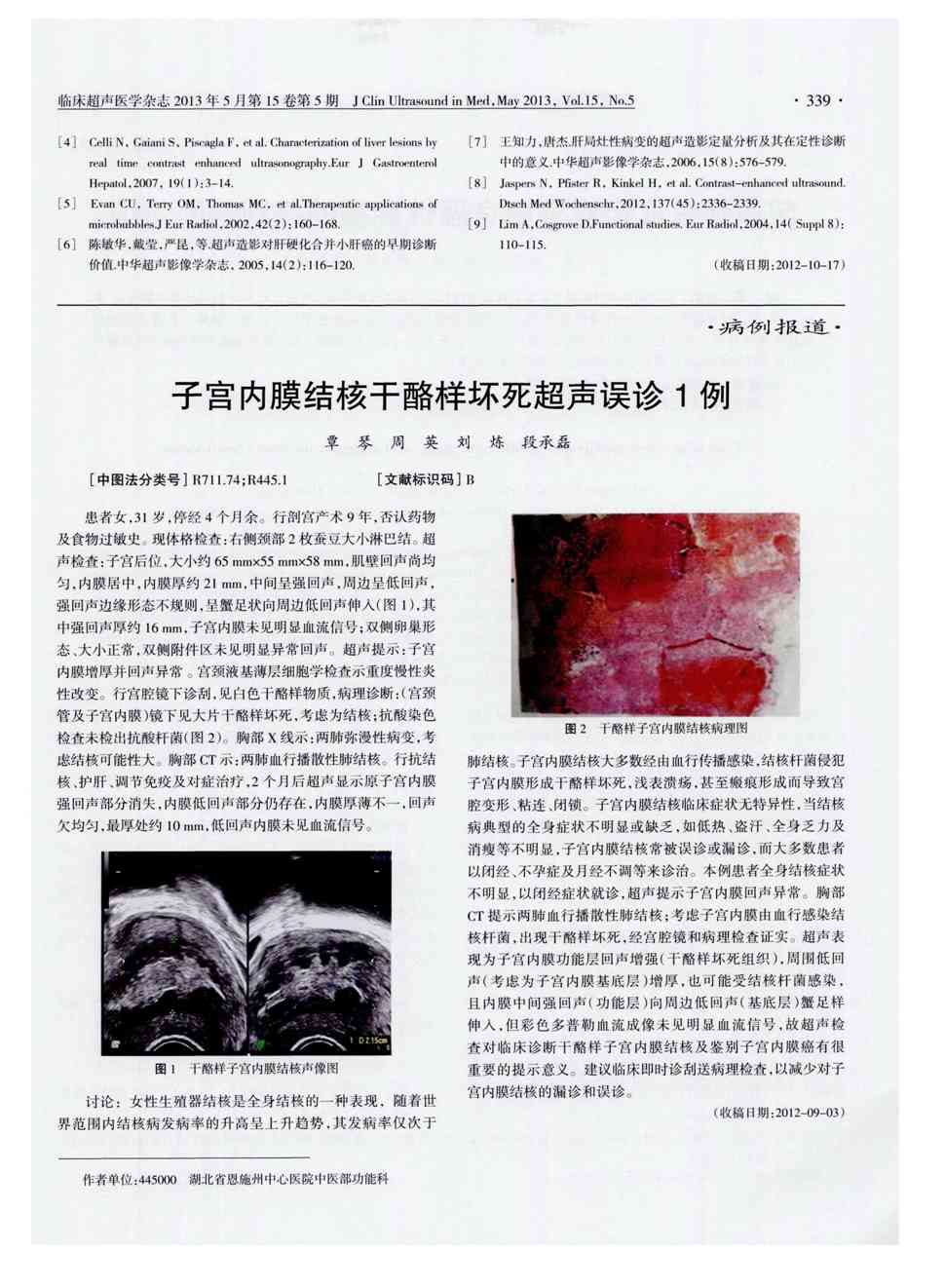 期刊子宫内膜结核干酪样坏死超声误诊1例被引量:1      患者女,31岁