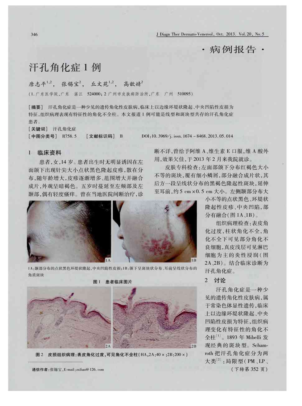 期刊汗孔角化症1例被引量:1      汗孔角化疵是一种少见的遗传角化性