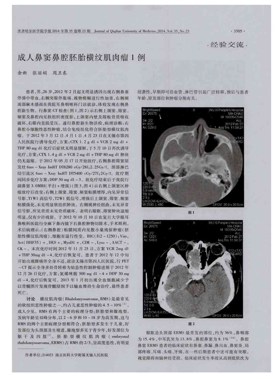 期刊成人鼻窦鼻腔胚胎横纹肌肉瘤1例     患者,男,26岁,2012年2月起