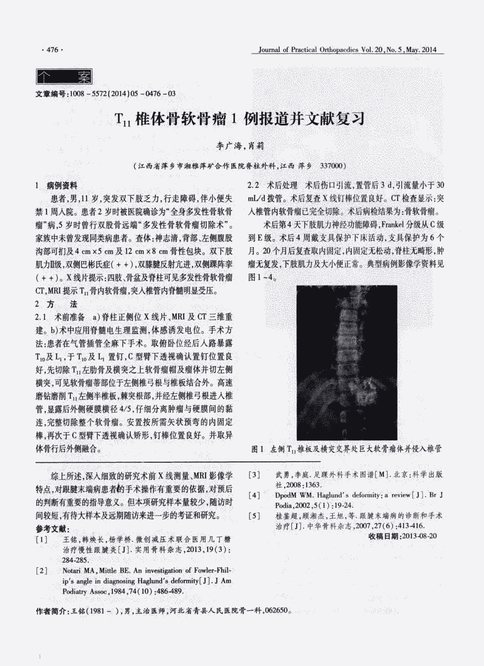 患者2岁时被医院确诊为"全身多发性骨软骨瘤"病,5岁时曾行双股骨远端"