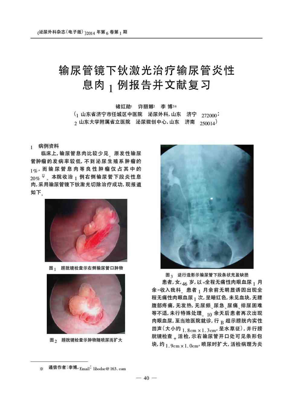 期刊输尿管镜下钬激光治疗输尿管炎性息肉1例报告并文献复习      1