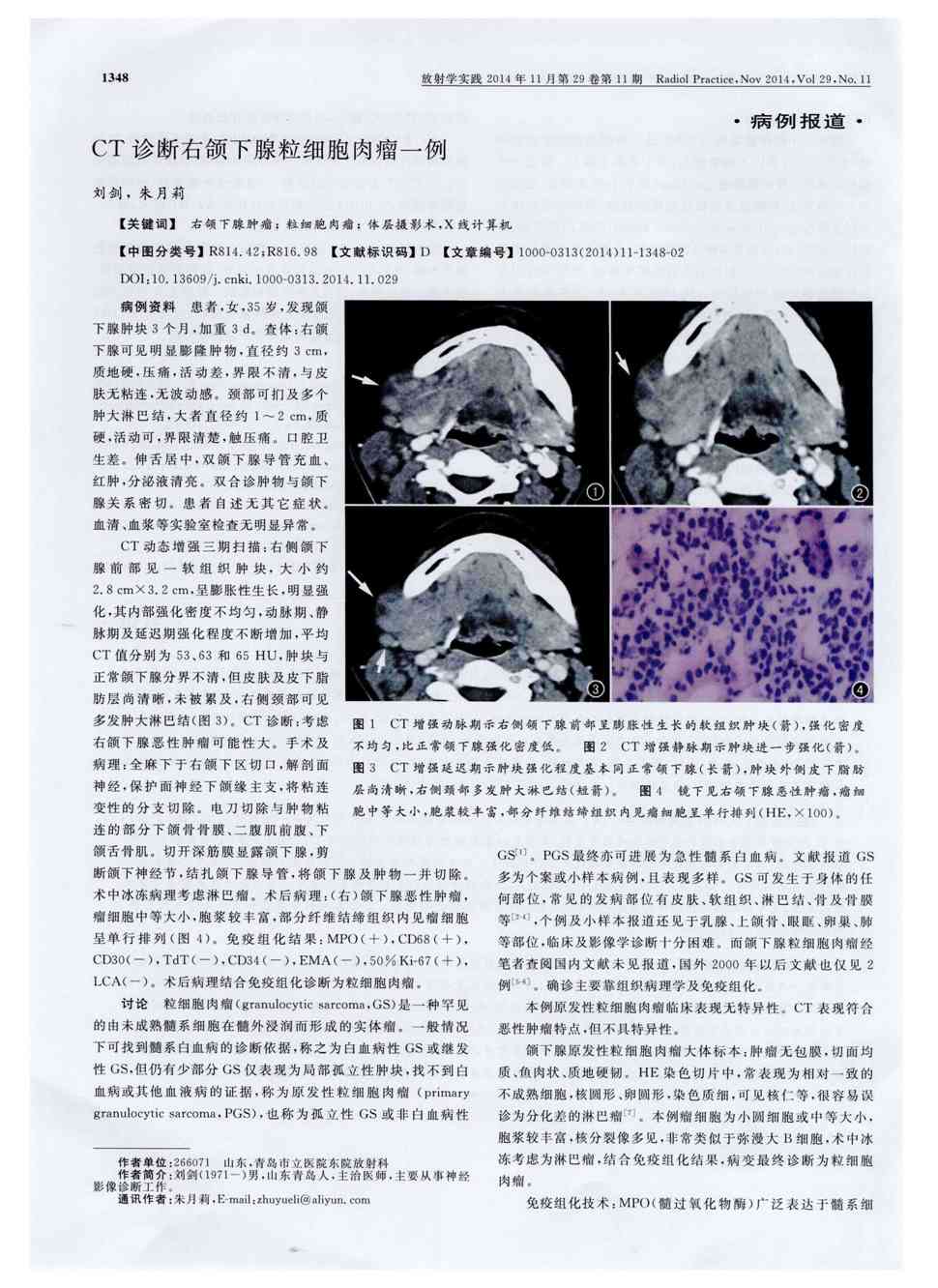 期刊ct诊断右颌下腺粒细胞肉瘤一例    病例资料患者,女,35岁,发现