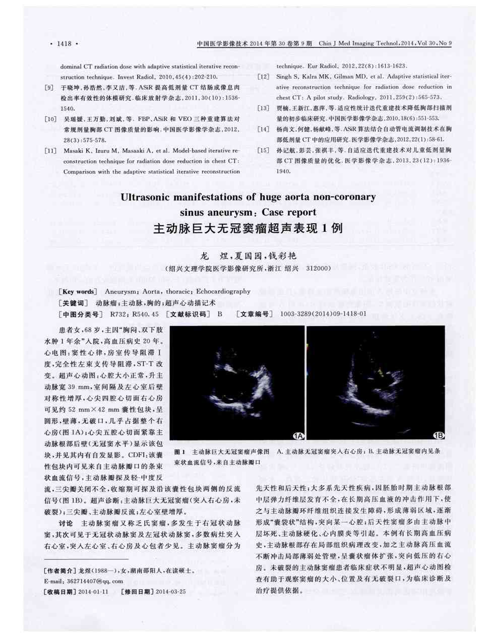 期刊主动脉巨大无冠窦瘤超声表现1例     患者女,68岁,主因"胸闷,双