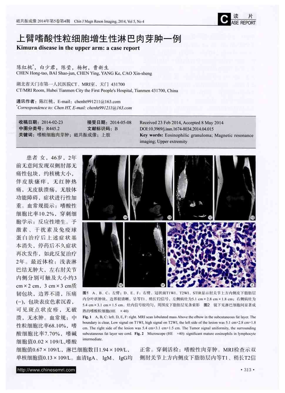 期刊上臂嗜酸性粒细胞增生性淋巴肉芽肿一例被引量:1       患者女