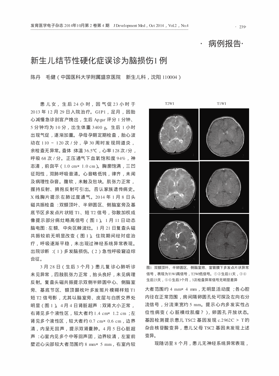 期刊新生儿结节性硬化症误诊为脑损伤1例    患儿女,生后24小时,因