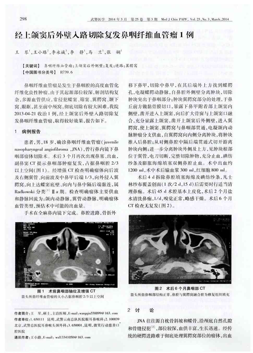 期刊经上颌窦后外壁入路切除复发鼻咽纤维血管瘤1例被引量:2