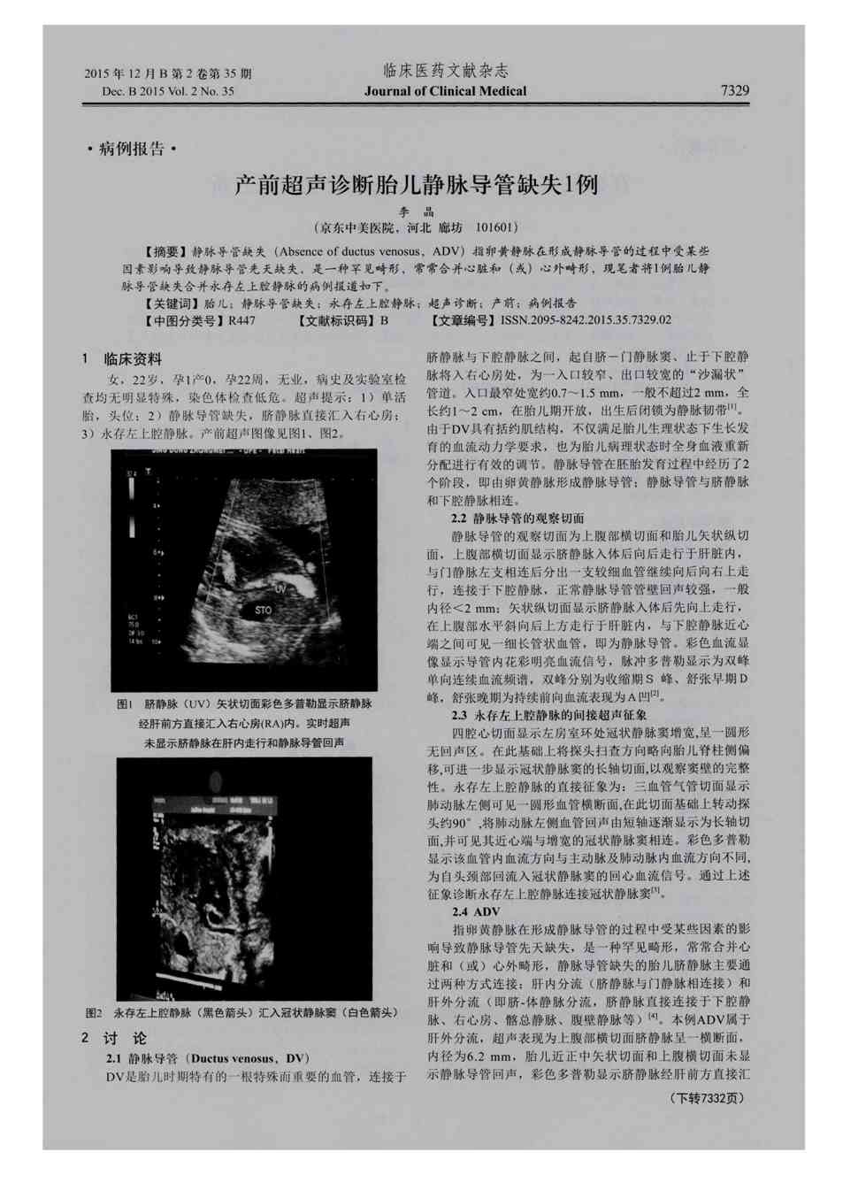 静脉导管缺失(absence of ductus venosus,adv)指卵黄静脉在形成静脉