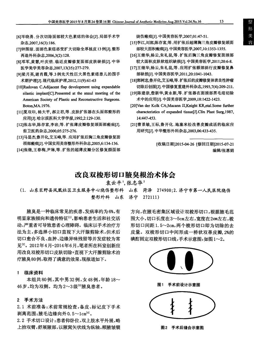 期刊改良双梭形切口腋臭根治术体会    腋臭是一种临床常见的疾患