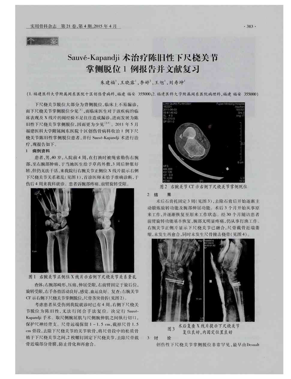 期刊sauvé-kapandji术治疗陈旧性下尺桡关节掌侧脱位1例报告并