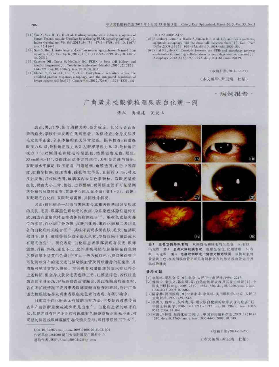 期刊广角激光检眼镜检测眼底白化病一例     患者,男,22岁,因自幼