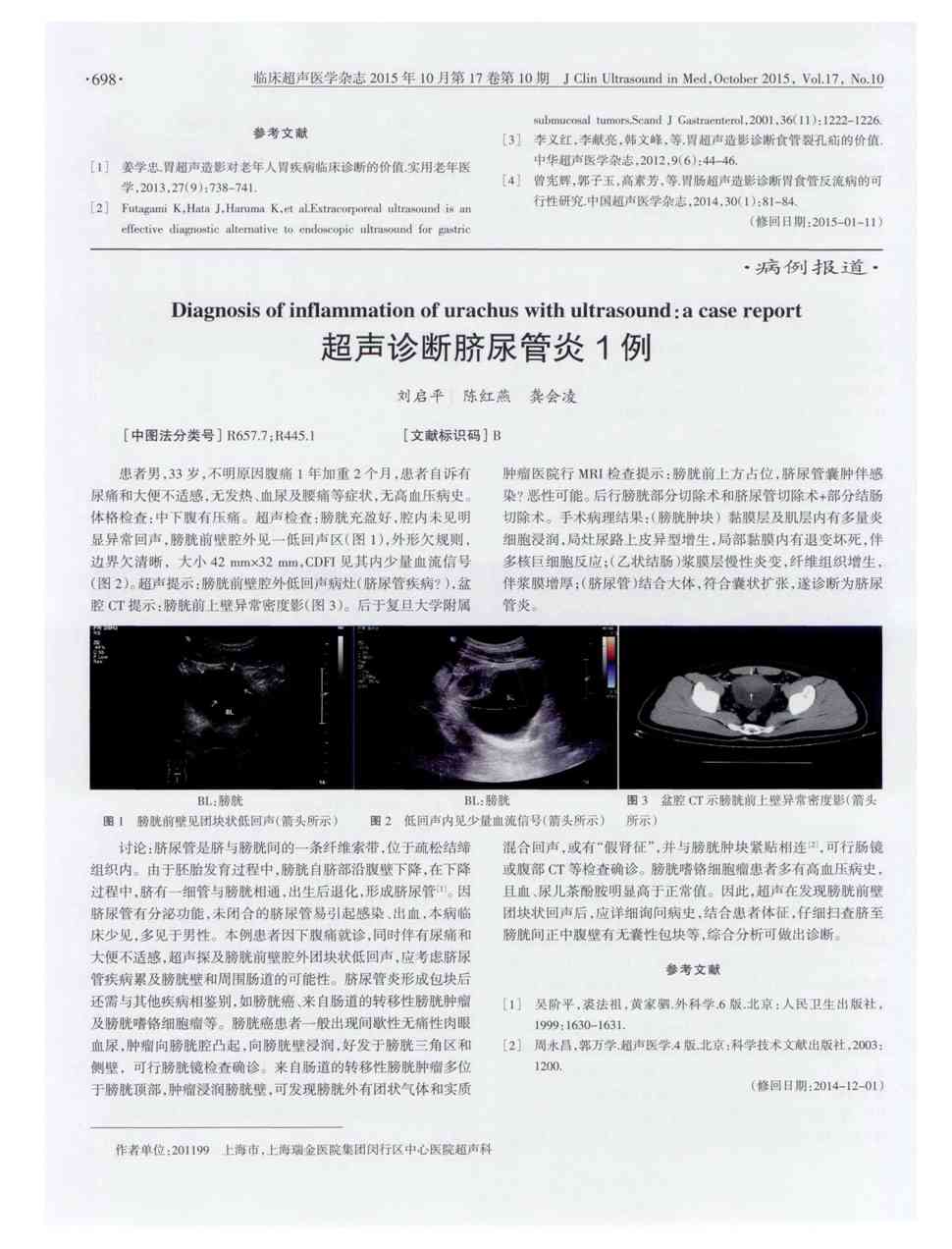 期刊超声诊断脐尿管炎1例被引量:1     患者男,33岁,不明原因腹痛1年